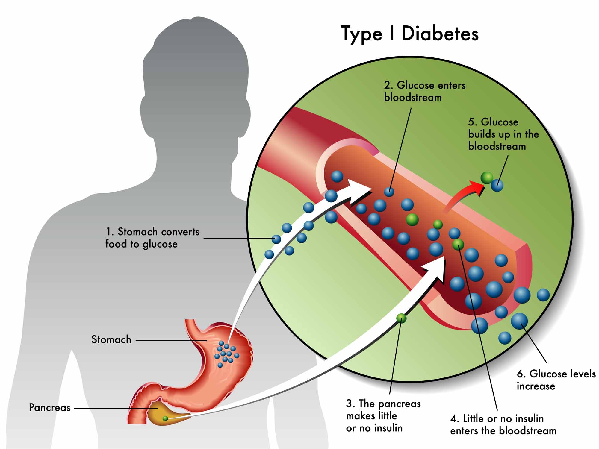 Type 1 Diabetes